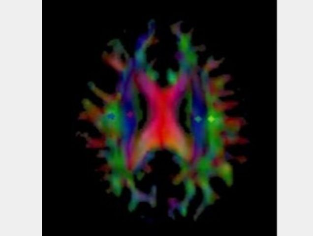 Mappa di un cervello con Alzheimer che mostra la diffusione dell'acqua come parte del flusso glinfatico. Con scansioni MRI prima e dopo l'inizio del trattamento, si è calcolato l'indice DTI-ALPS. I colori mostrano le regioni di interesse nel cervello. Fonte: Osaka Metropolitan University Water diffusion in glymphatic flow