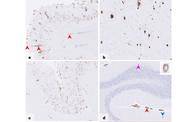 amyloid deposits Nature