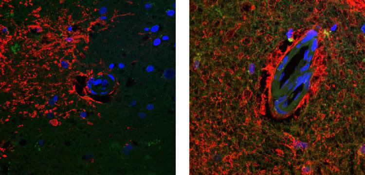 Aquaporina-4: nuovo possibile obiettivo contro l'Alzheimer