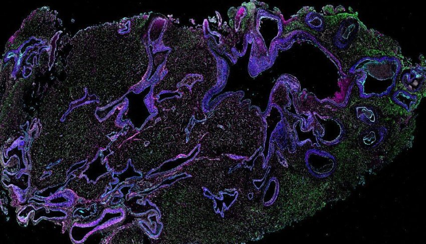 arteriovenous malformation avm