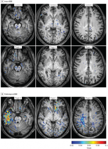 I danni nascosti al cervello dei giocatori di sport violenti che possono protare all'Alzheimer