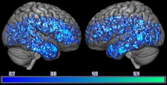 C'è un legame tra carenza di serotonina e demenza