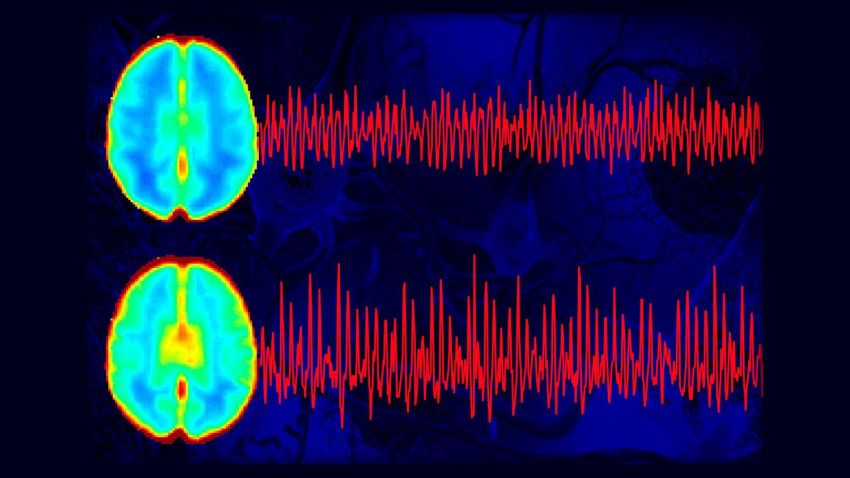 brain pulses differently in alzheimer