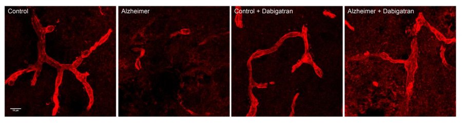 cerebral vessels red damaged by AD