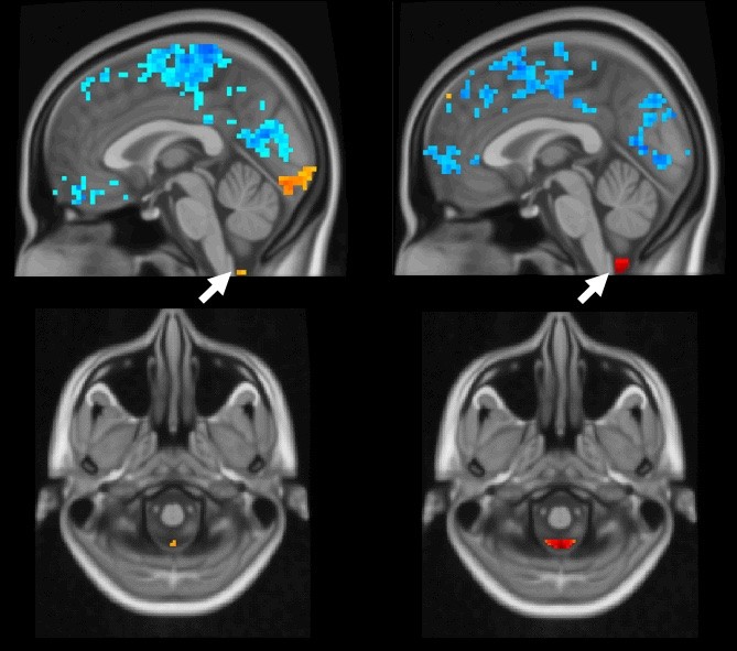 cerebral spinal fluid moving