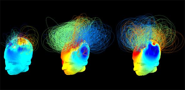 Scoperte 'firme cerebrali nascoste' di consapevolezza in pazienti in stato vegetativo