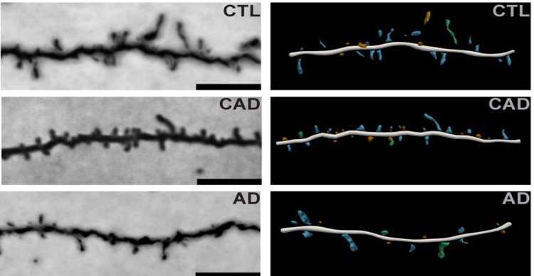 La struttura del cervello rende alcune persone resilienti all'Alzheimer