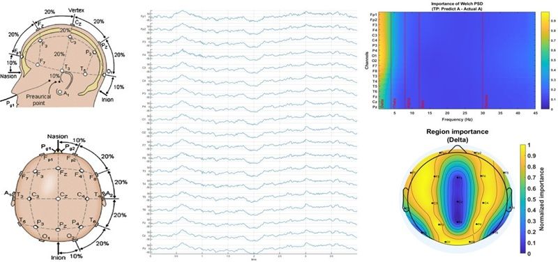 I sensori EEG registrano l’attività cerebrale (a sinistra), generando segnali di onde cerebrali (al centro) che vengono analizzati dall’AI spiegabile (in alto a destra) e mappati sulle regioni del cervello (in basso a destra) per rilevare e interpretare il tipo e la gravità della demenza in modo non invasivo. Fonte: Vo et al /Biomedical Signal Processing and Control eeg dementia graph