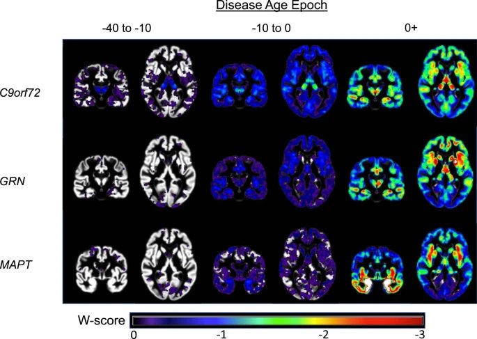 fFTD by disease age