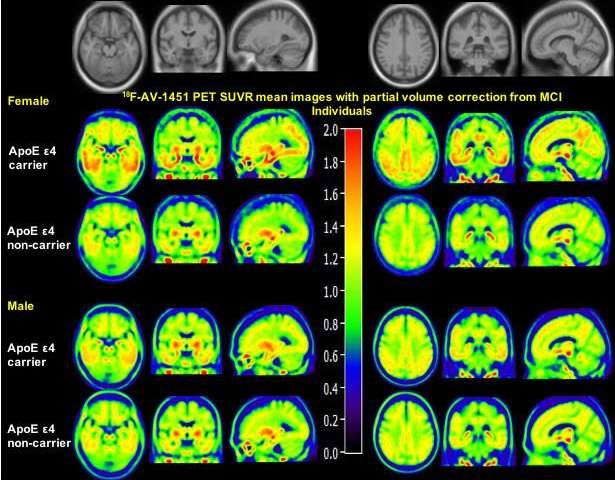 female male brain scans apoe4