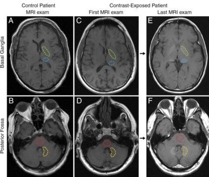 Nessuna prova che il gadolinio (contrasto in RM) alzi rischio di declino cognitivo