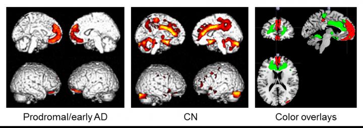 Metabolismo ridotto del glucosio associato a stato nutrizionale dell'Alzheimer