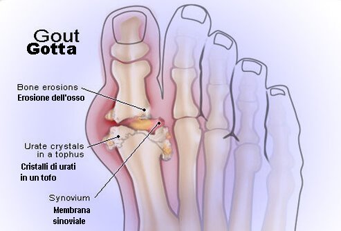 Gotta negli anziani legata a rischio più alto di demenza