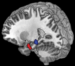 Perdita di cellule che producono dopamina potrebbe essere primo segno dell'Alzheimer