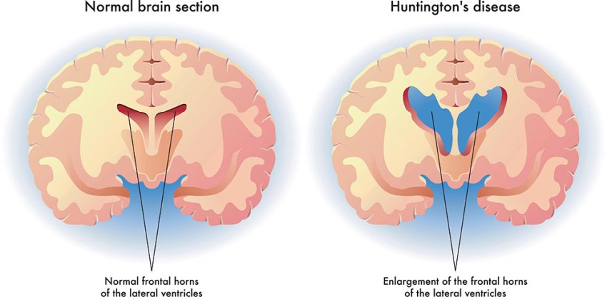 huntingtons disease