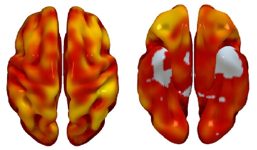 hypertension closed associated with reduced brain metabolism