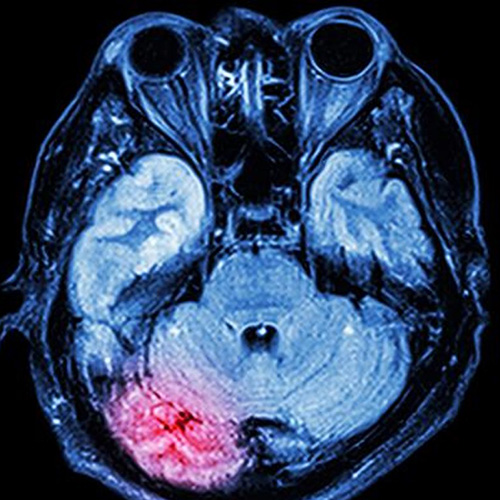 inflamed brain area after concussion