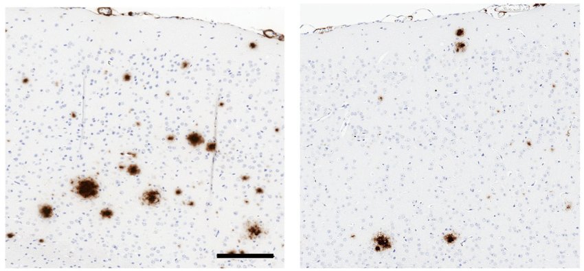 Nuova bioterapia potenziale per l'Alzheimer