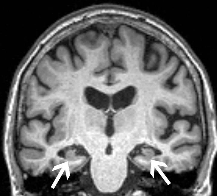 loss of volume anxiety