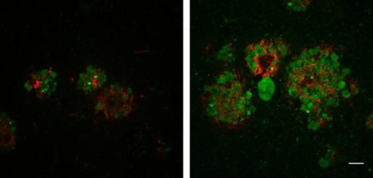 Trasporto difettoso dei lisosomi promuove le placche di Alzheimer