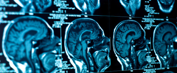 Vuoi un cervello sano? Meglio evitare queste 7 abitudini