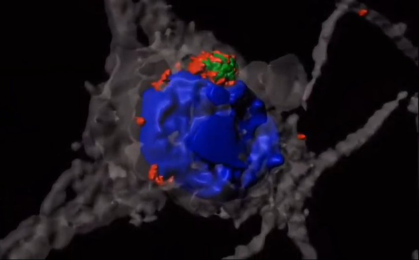 nerve cells with aggregate of huntingtin tagged by ubiquitin chains