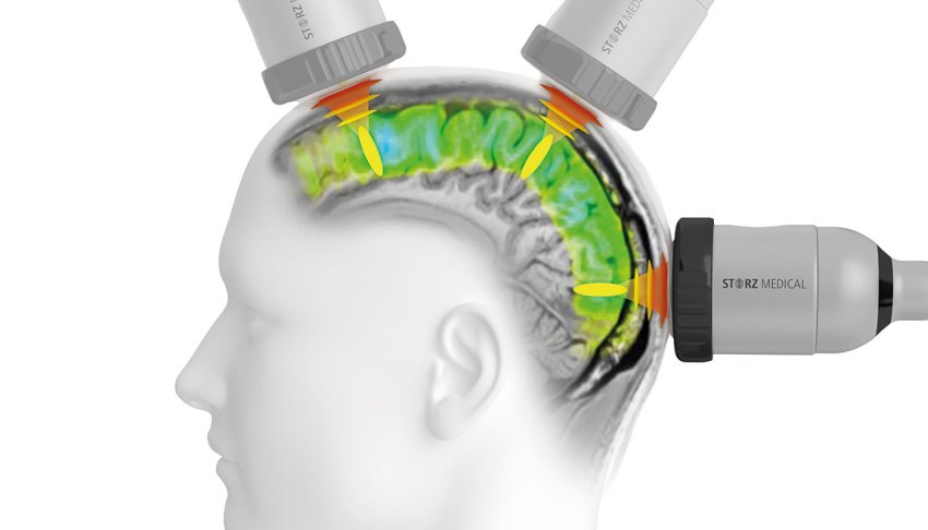 neurolith transcranial pulse stimulation with ultrasound