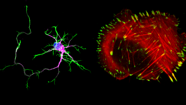 neuron and cancer cell with protein sorla