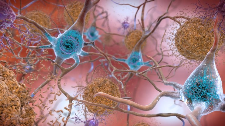 neurons with amyloid and ptau