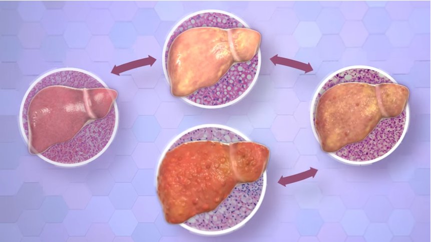 non alcoholic fatty liver disease