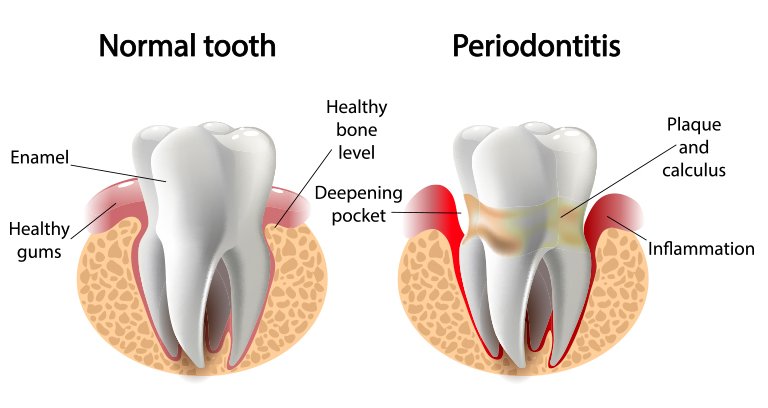 normal tooth vs periodontitis