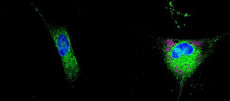 normal astrocyte and astrocyte secreting toxic lipids