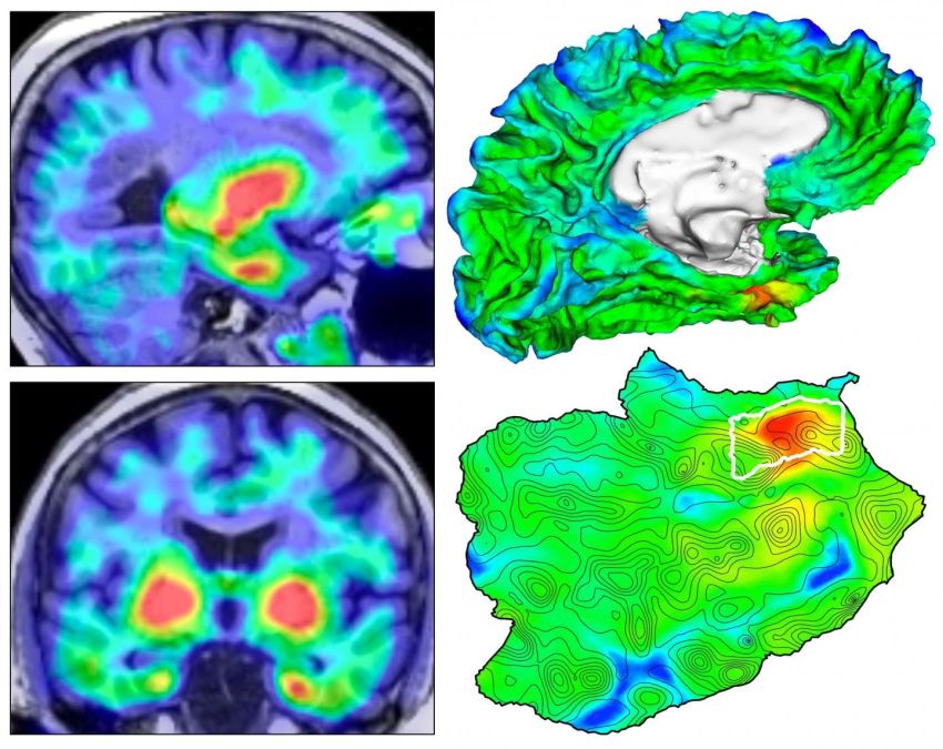 origin of tauopathy in vivo