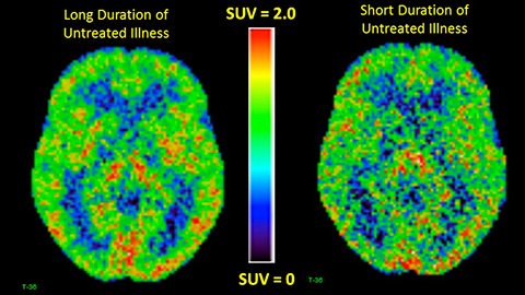 Negli anni, la depressione cambia il cervello