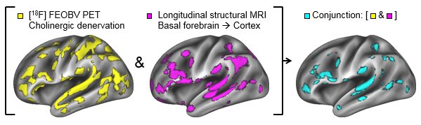 Scoperto il percorso della neurodegenerazione dell'Alzheimer