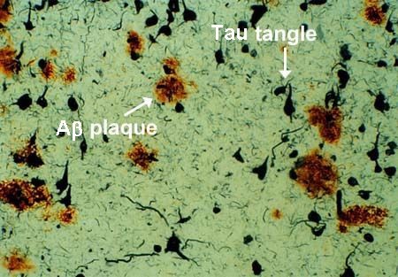 amyloid plaque and neurofibrillary tangles 