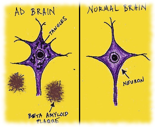 Scoperto accumulo di amiloide di Alzheimer nel cervello di ventenni