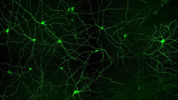 L'Alzheimer danneggia la vista, distruggendo gli schemi del sonno