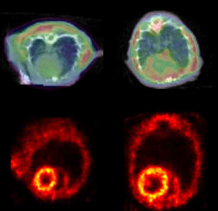 Insufficienza cardiaca: l'Alzheimer è una malattia del cuore?