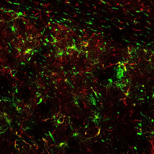 Trattamento con cellule staminali riduce deterioramento causato da demenza con corpi di Lewy