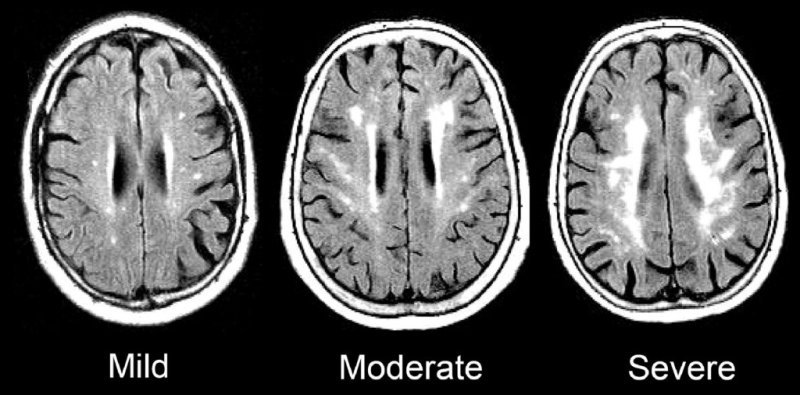 Infiammazione cronica da mezza età a vecchiaia è legata alla demenza